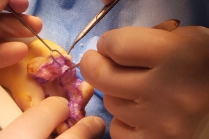 Новости Винницы и области / У Вінниці провели унікальну операцію однорічному хлопчику з рідкісною вадою рук / Інформаційний портал На Париже Новини Вінниці / У Вінниці провели унікальну операцію однорічному хлопчику з рідкісною вадою рук