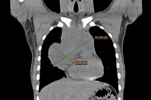 Новини Вінниці / У Вінниці успішно прооперували двох дітей з складними пухлинами грудної клітки