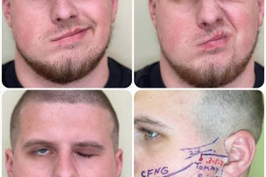 Новини Вінниці / У Вінниці вперше провели складне лікування паралічу обличчя у пораненого військового